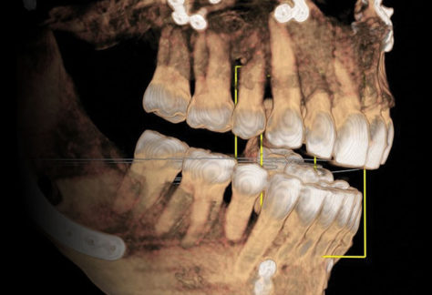Cone Beam Directed Surgery
